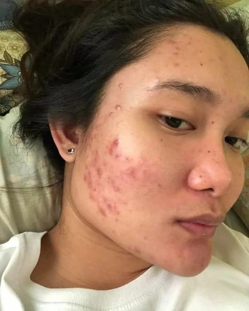 Nguyên nhân chính gây mụn trán?