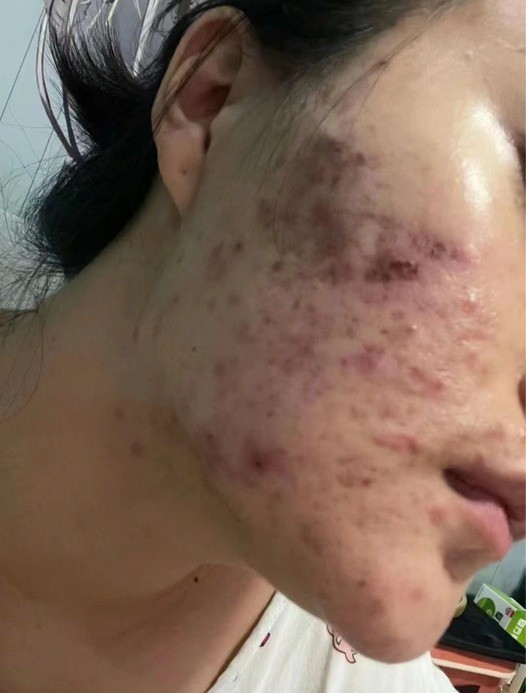 Nguyên nhân chính gây mụn má?