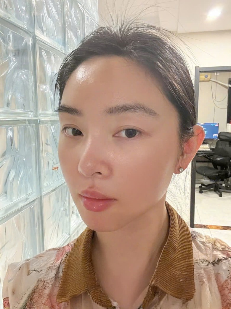 Nguyên nhân chính gây mụn lưng?