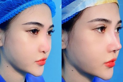 Ai không nên nâng mũi – Lưu ý an toàn trước phẫu thuật