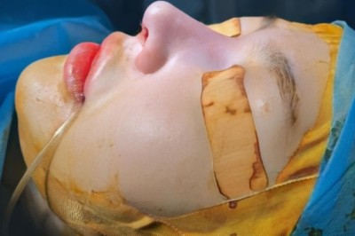 Cách giảm sưng bầm sau nâng mũi – Bí quyết hồi phục nhanh