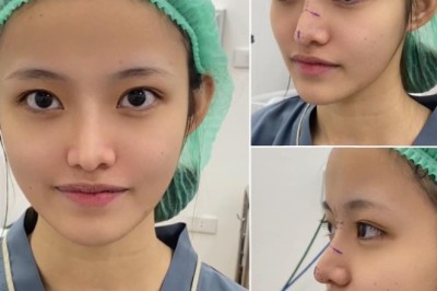 Khi nào nên chỉnh sửa mũi sau phẫu thuật?
