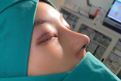 Sưng nề sau nâng mũi kéo dài bao lâu?