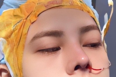 Ăn uống sau nâng mũi – Những lưu ý