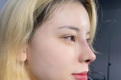 Dáng mũi cho mặt trái tim