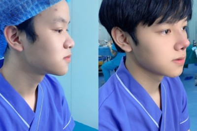 Dáng mũi nam tính – Đặc điểm