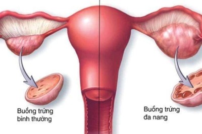 Hội chứng buồng trứng đa nang – nguyên nhân gây vô sinh hàng đầu