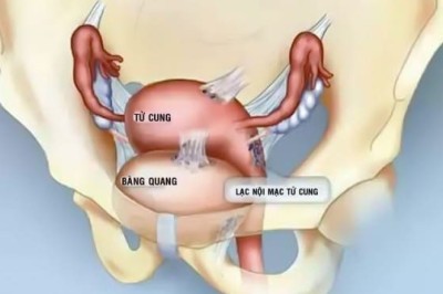 Lạc nội mạc tử cung – thủ phạm gây đau bụng kinh dữ dội