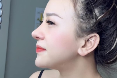 Lệch sống mũi sau nâng – Nguyên nhân