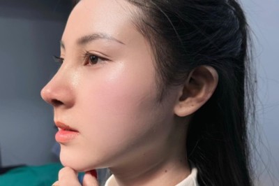 Lộ sống mũi sau nâng – Cách phòng tránh
