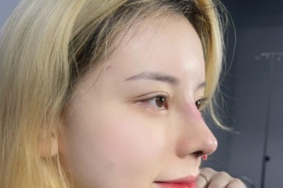 Mũi đỏ, bóng – Khi nào cần tái khám