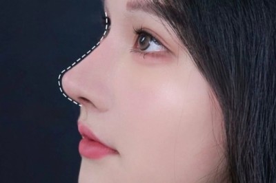 Nâng mũi bọc sụn – Ưu điểm chính