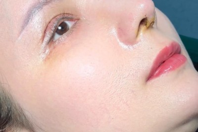 Nâng mũi và điều chỉnh trán – Khi nào cần