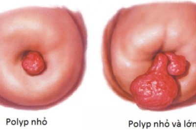 Polyp cổ tử cung – dấu hiệu cảnh báo chớ nên chủ quan