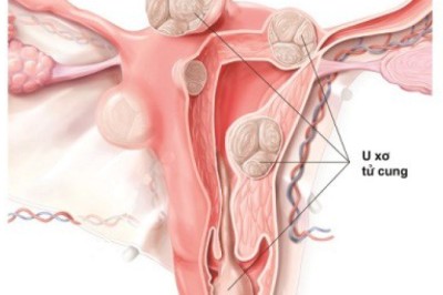 U xơ tử cung – khối u lành tính nhưng tiềm ẩn biến chứng