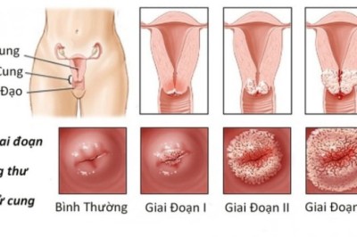 Ung thư cổ tử cung – kẻ giết người thầm lặng của phụ nữ