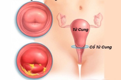 Viêm cổ tử cung – căn bệnh gây vô sinh âm thầm