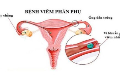 Viêm phần phụ – nỗi lo của phụ nữ sau sinh và nạo hút thai