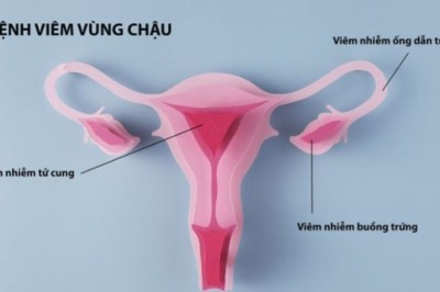 Viêm vùng chậu – nguyên nhân gây vô sinh ở nữ giới