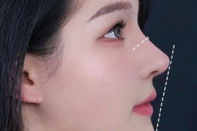 Nhiễm trùng sau nâng mũi – Nguyên nhân