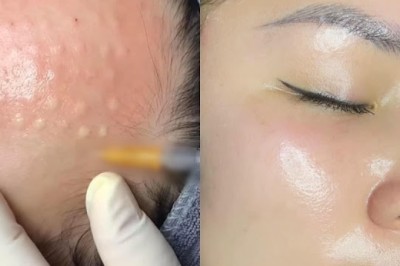 Ai Không Nên Tiêm Meso? Lời Khuyên Từ Chuyên Gia