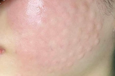 Tiêm Meso Bao Nhiêu Lần Là Hiệu Quả? Hướng Dẫn Chuyên Gia