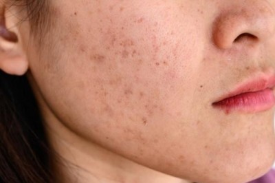 Nám Da Do Kem Trộn, Mỹ Phẩm Kém Chất Lượng – Giải Pháp Điều Trị