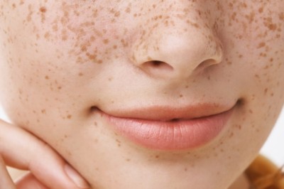Nám Kết Hợp – Khi Nám Mảng Và Nám Chân Sâu Cùng Xuất Hiện