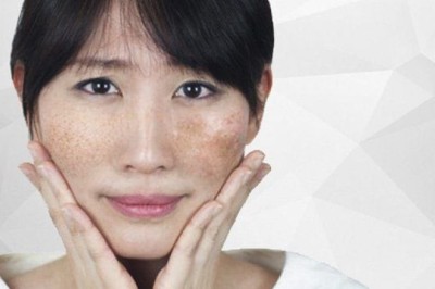Trị Nám Bằng Glutathione – Làm Sáng Da & Chống Oxy Hóa
