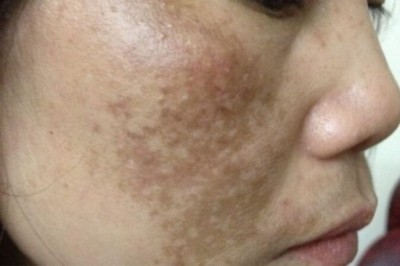 Trị Nám Bằng HIFU – Nâng Cơ, Làm Sáng Da