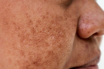 Trị Nám Bằng Laser – Giải Pháp Tận Gốc Cho Làn Da Sáng Mịn