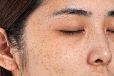 Trị Nám Cho Da Nhạy Cảm – Liệu Trình Dịu Nhẹ Không Gây Kích Ứng