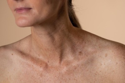 Trị Nám Do Nội Tiết – Liệu Pháp Kết Hợp Từ Trong Ra Ngoài