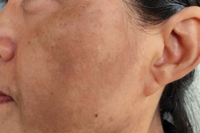 Trị Nám Đông Y Kết Hợp Công Nghệ Hiện Đại – Hiệu Quả Lâu Dài