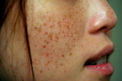 Trị Nám Kết Hợp – Phác Đồ Cá Nhân Hóa Hiệu Quả Dài Lâu
