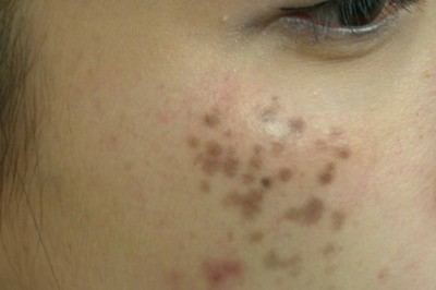 Trị Nám Laser Pico – Xóa Sạch Nám An Toàn, Không Tái Phát