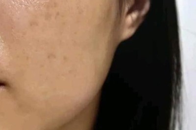 Trị Nám Laser Toning – Nhẹ Nhàng, An Toàn Cho Mọi Làn Da