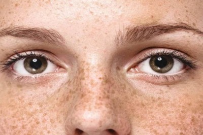 Trị Nám Meso Therapy – Phương Pháp Tiêm Trực Tiếp, Hiệu Quả Cao