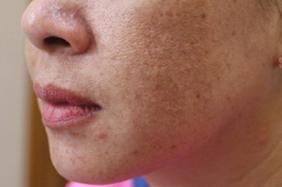 Trị Nám Mesotherapy – Tiêm Dưỡng Chất Trực Tiếp, Mờ Nám Từ Gốc
