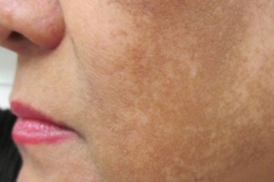 Trị Nám Peel Da Y Khoa – Làm Mờ Nám, Tái Tạo Làn Da Sáng Khỏe