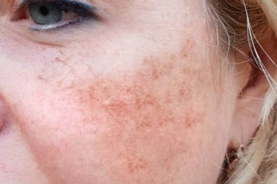 Trị Nám PicoSure – Công Nghệ Laser Thế Hệ Mới, Hiệu Quả Vượt Trội