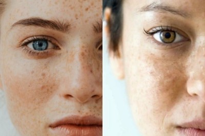Trị Nám PRP – Giải Pháp Tái Sinh Da, Làm Mờ Nám Tự Nhiên