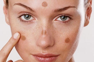 Trị Nám Sau Sinh – An Toàn, Hiệu Quả Cho Mẹ Bỉm Sữa
