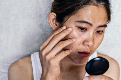 Trị Nám Và Tàn Nhang Cùng Lúc – Hiệu Quả An Toàn