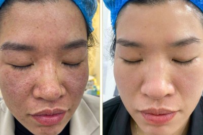 Trị Nám Bằng Axit Hyaluronic + Meso – Dưỡng Da Sâu & Phục Hồi