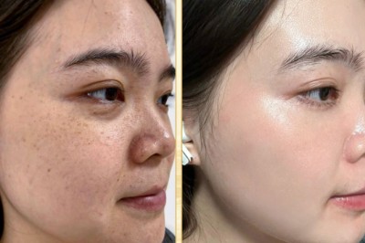 Trị Nám Bằng Meso Therapy – Dưỡng Chất Thẩm Thấu Sâu, Hiệu Quả