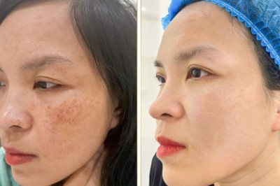 Trị Nám Bằng Peeling Hoạt Chất – Lột Da An Toàn, Hiệu Quả