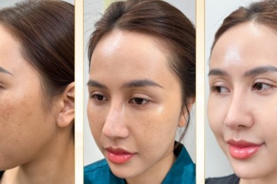 Trị Nám Bằng Vitamin C – Chống Oxy Hóa & Làm Sáng Da