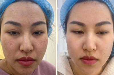 Trị Nám Kết Hợp Laser Fractional CO2 – Phục Hồi Da Toàn Diện