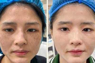 Trị Nám Kết Hợp Niacinamide – Dưỡng Da & Ngăn Tái Phát